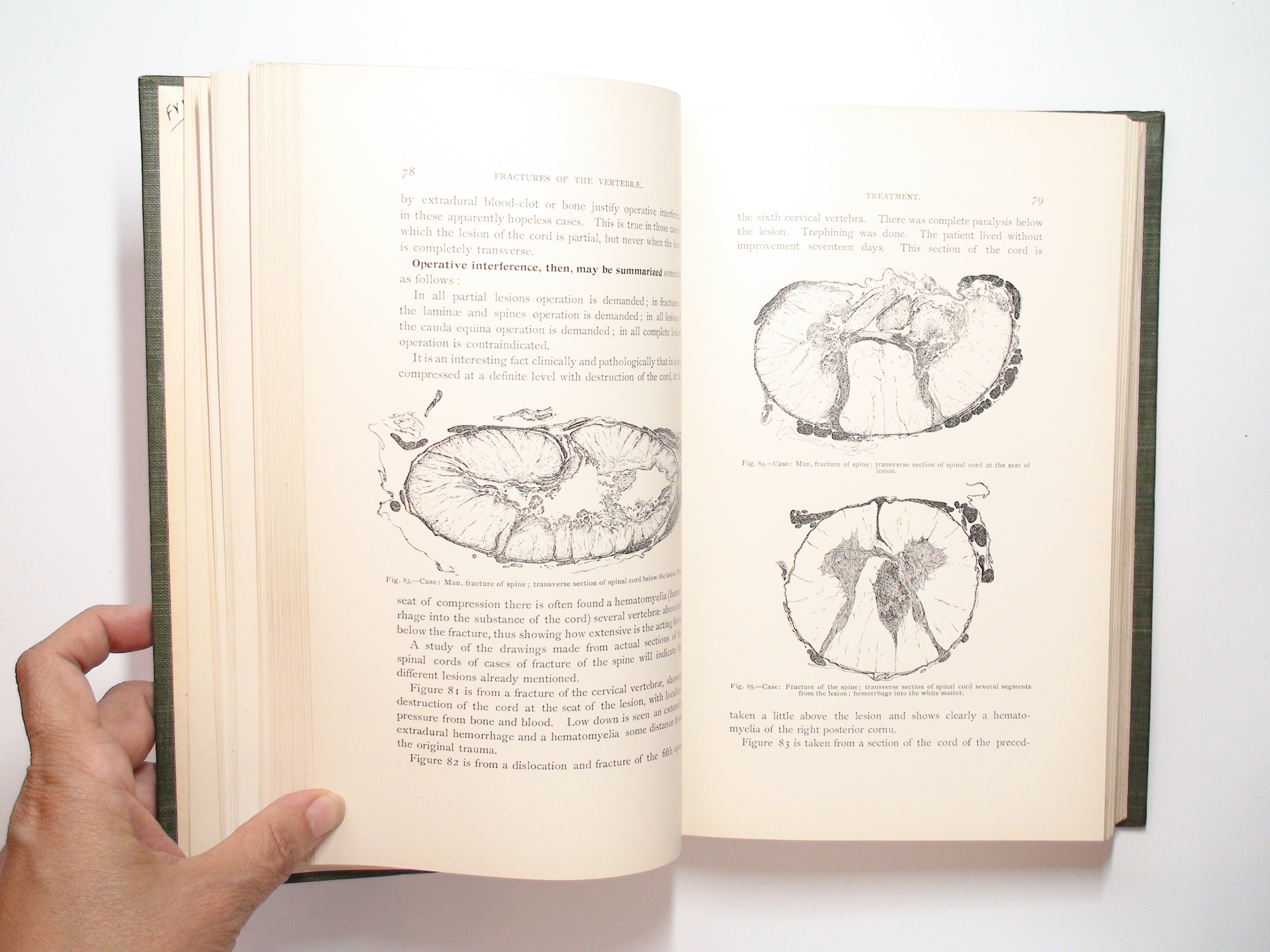 Treatment of Fractures, Charles Locke Scudder, Illustrated, 1st Ed, 1900