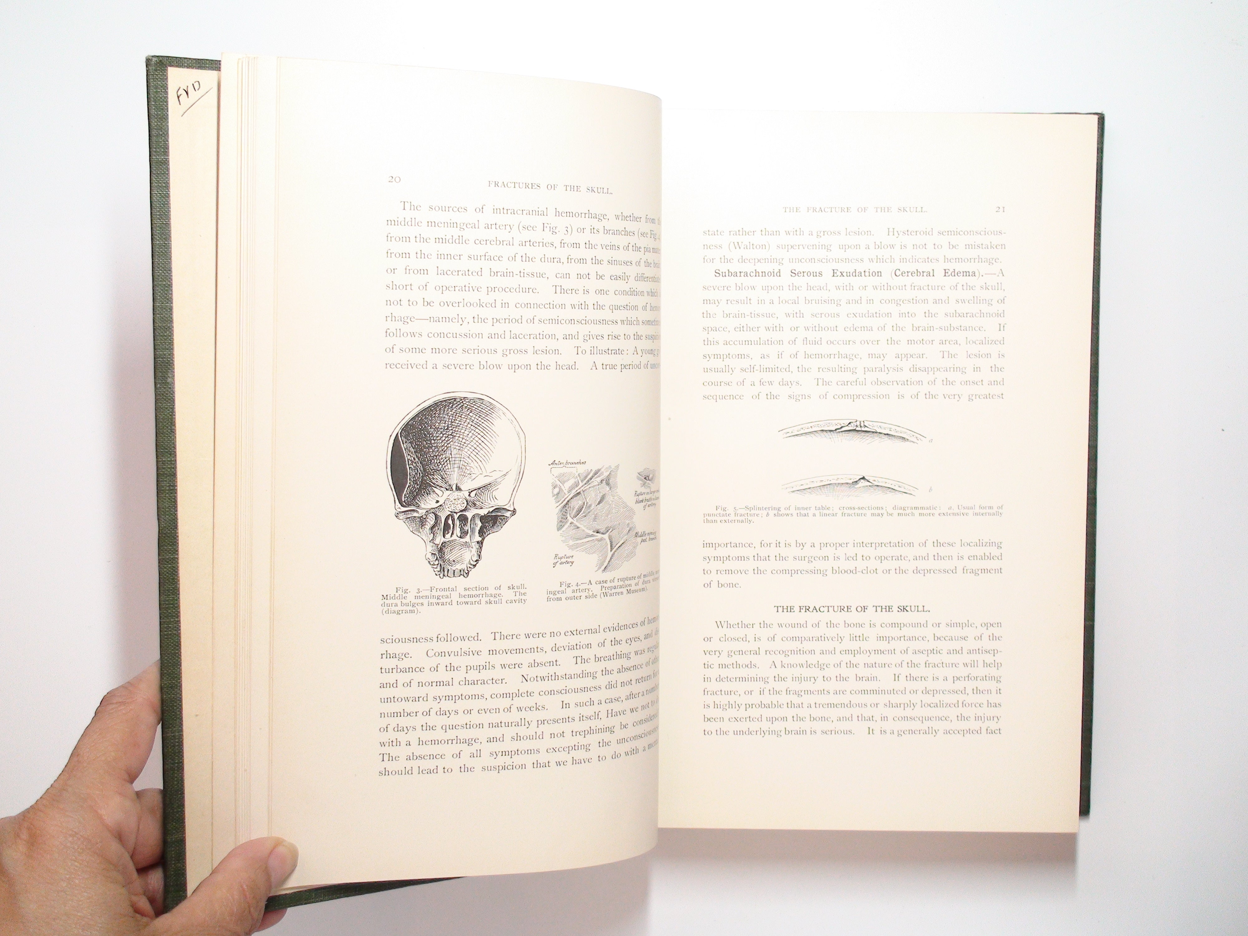 Treatment of Fractures, Charles Locke Scudder, Illustrated, 1st Ed, 1900